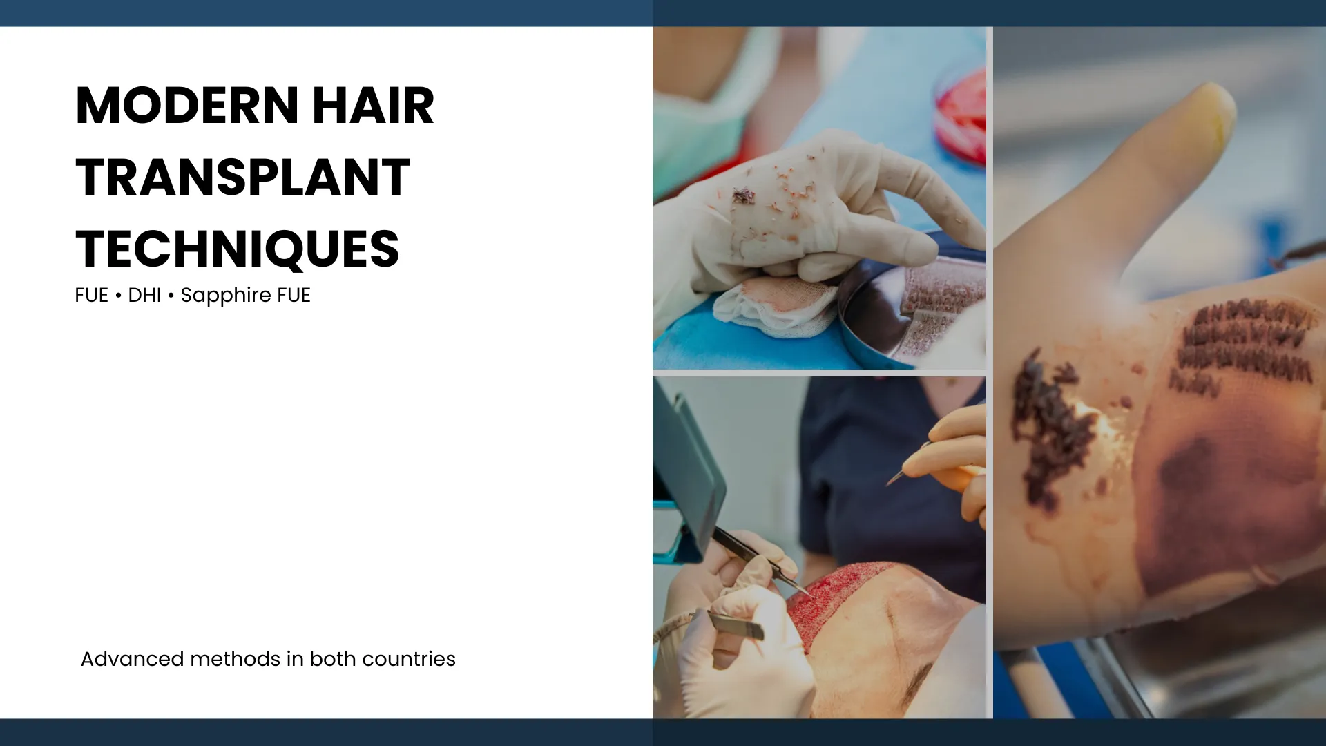 Hair Transplant Kuwait Vs Turkey - Cost, Quality And Facts 3 Surgical Techniques As The Foundation Of Procedures In Both Countries