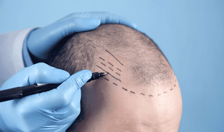 Hair Transplant Turkey Clinics