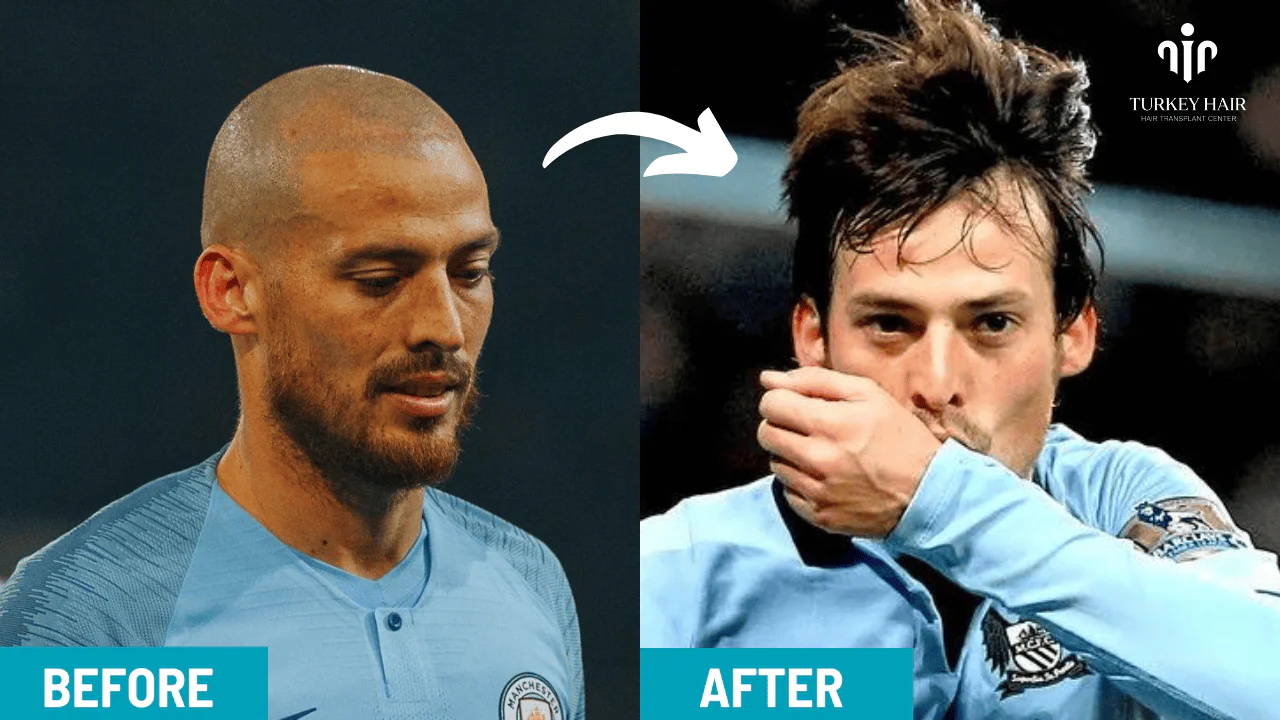 David Silva Hair Transplant Results