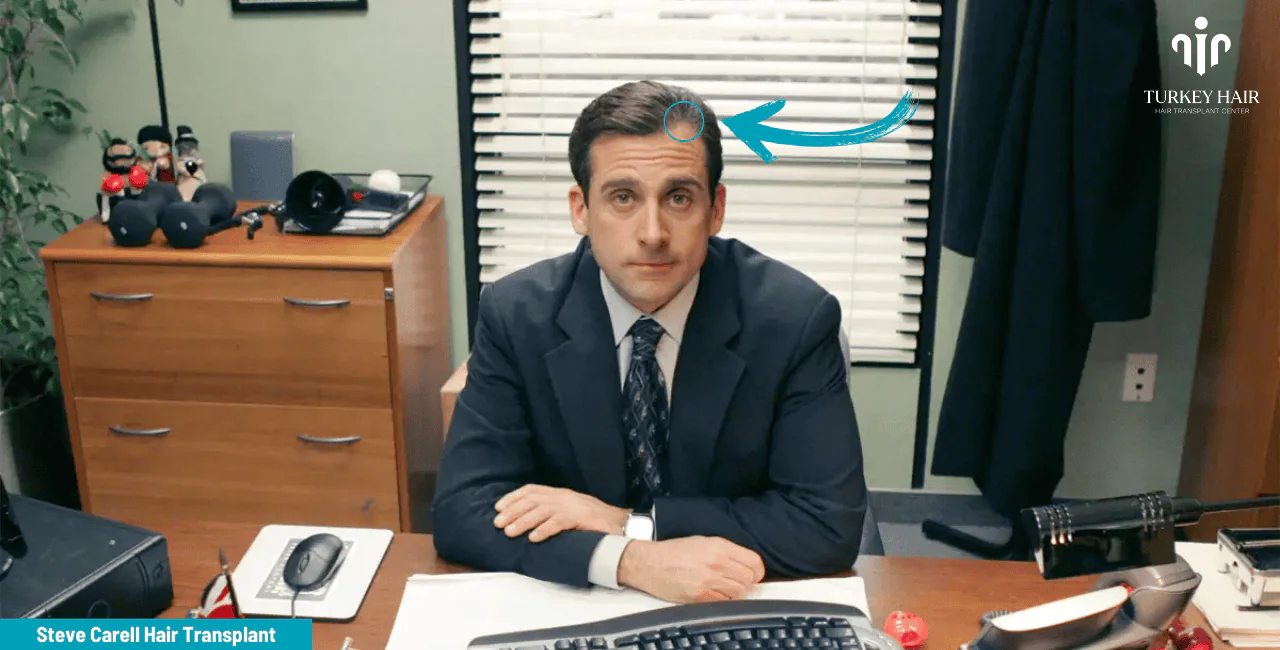 Steve Carell'S Hair Transplant (1) Steve Carell