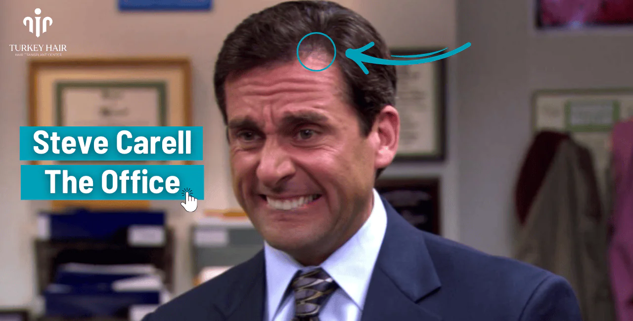 Steve Carell'S Hair Transplant (2) Steve Carell’s Hair Transplant