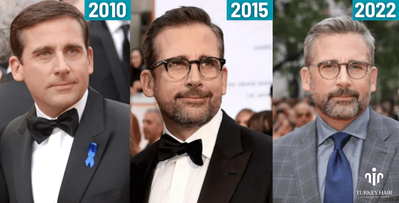 Steve Carell'S Hair Transplant (5) Steve Carell