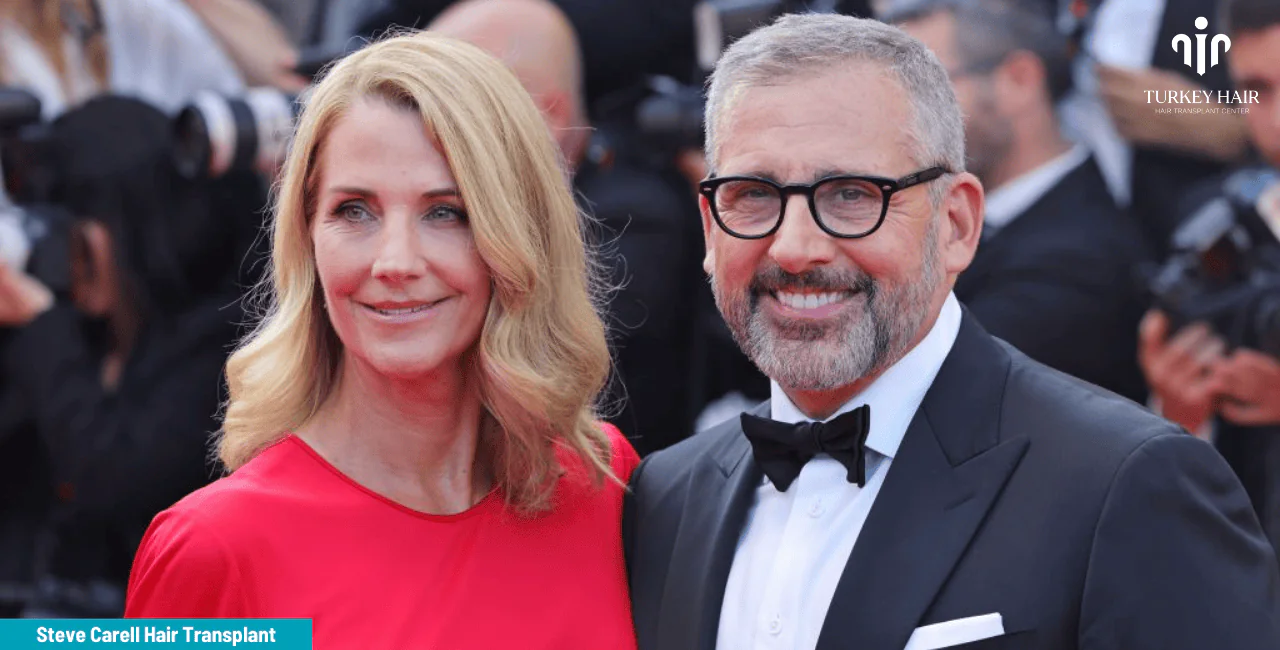 Steve Carell'S Hair Transplant (7) Steve Carell’s Hair Transplant