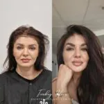Female Hair Transplant Before And After