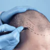 Turkey Cosmetic And Hair Transplant Center