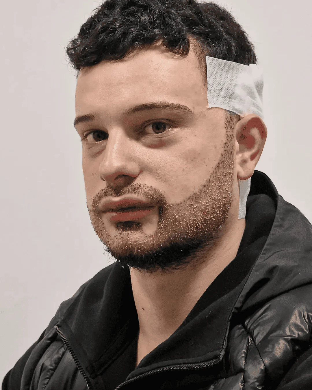 Beard Transplant In Turkey