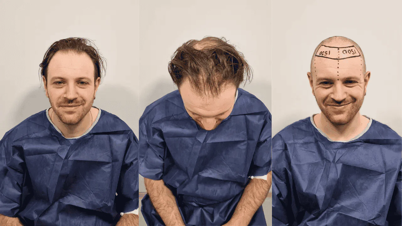 Affordable Hair Transplant Turkey