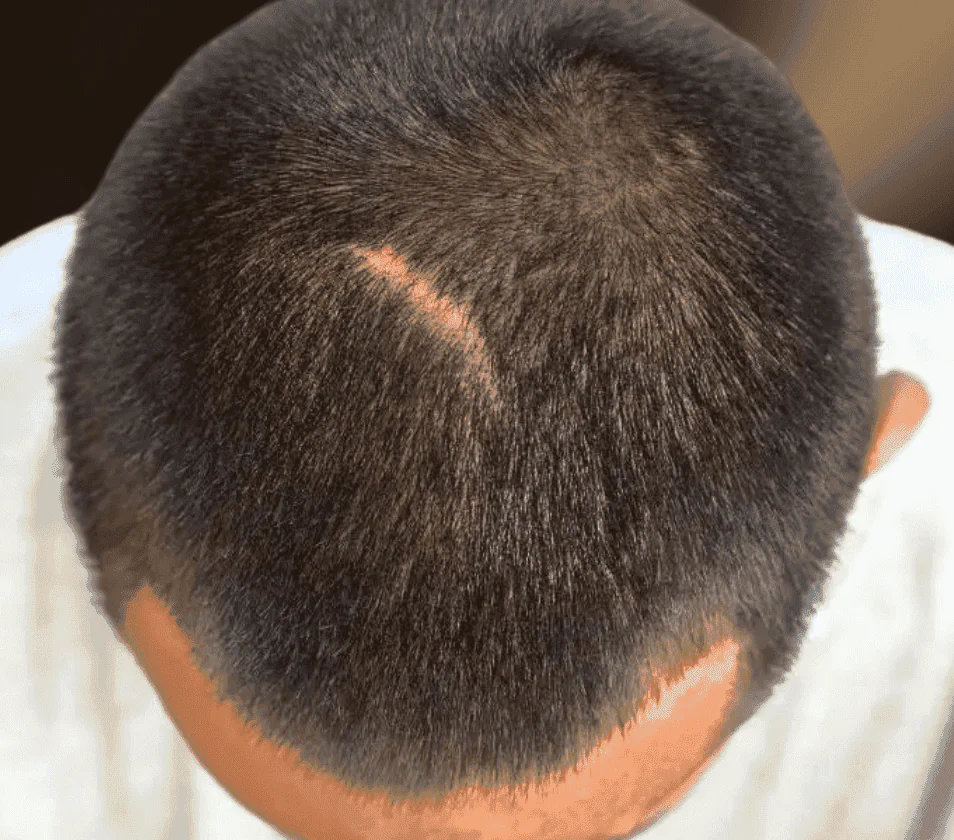 Fix Scar Hair Transplant