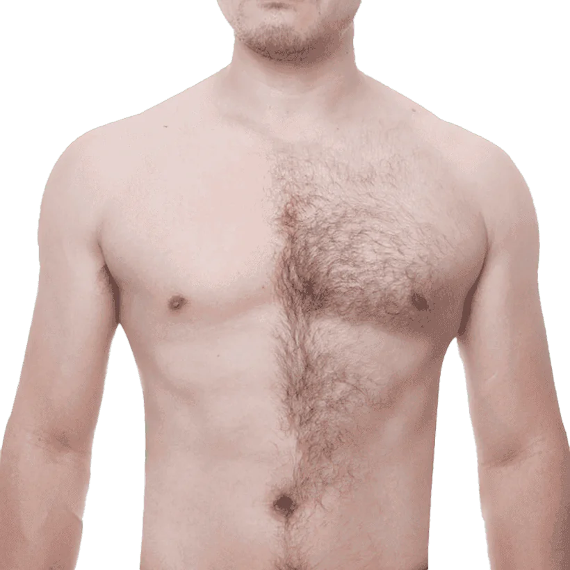 Body-Transplant-Bg11 Body Hair Transplant