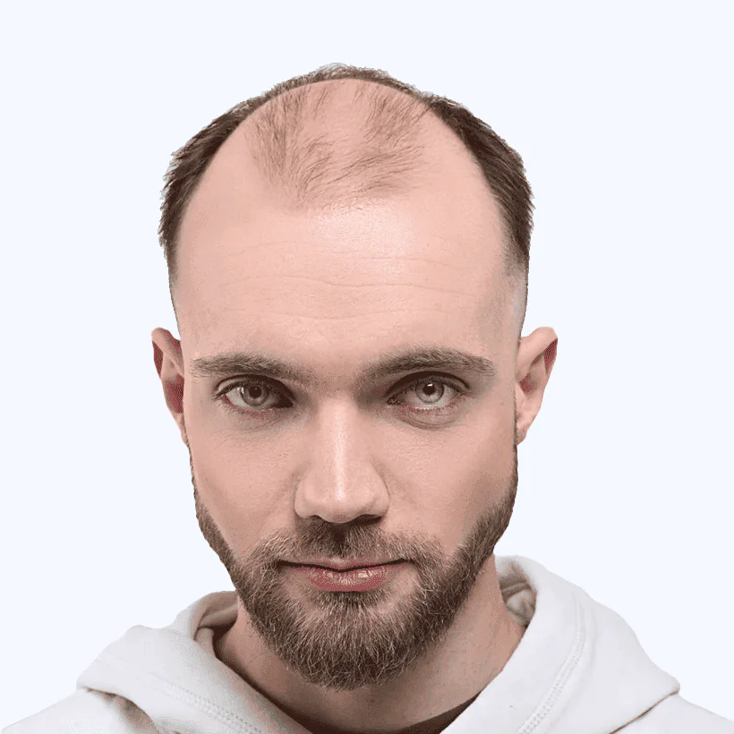 Turkey Hair Transplant Center