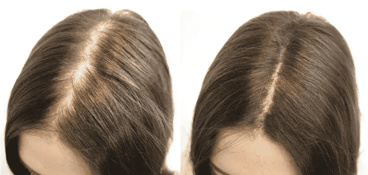 Hair Transplant For Women