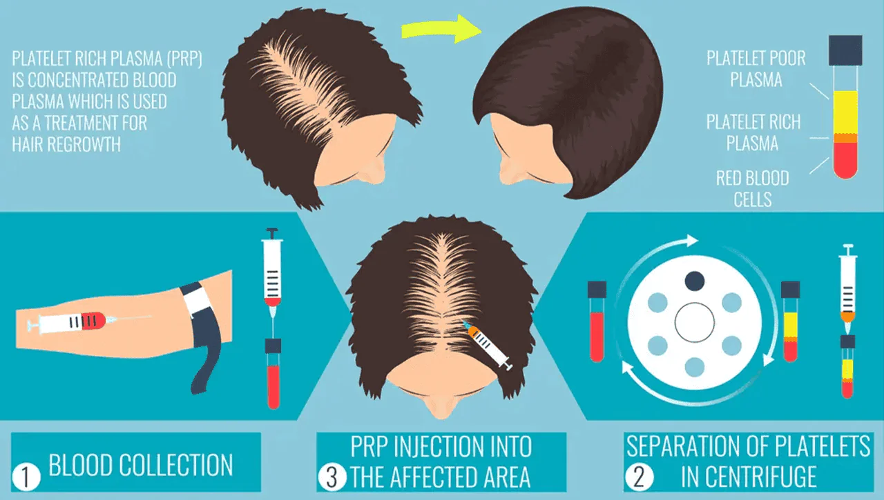Prp Or Platelet Rich Plasma Hair Treatment