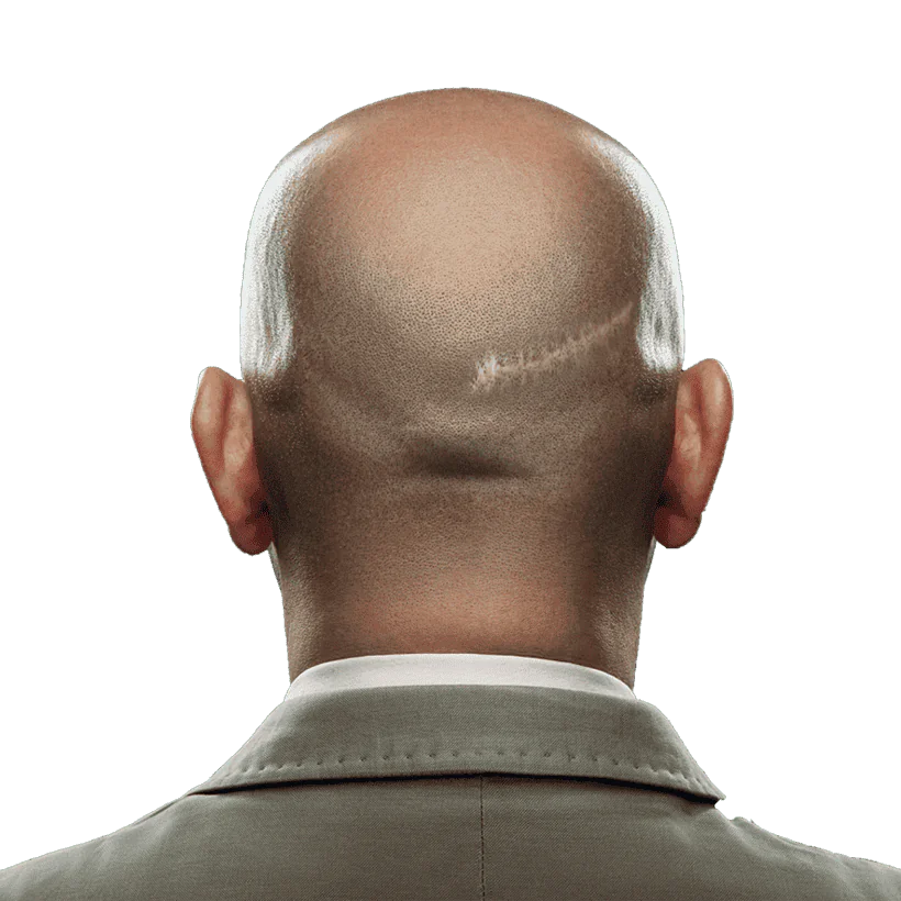Celebrity Hair Transplant Scar​