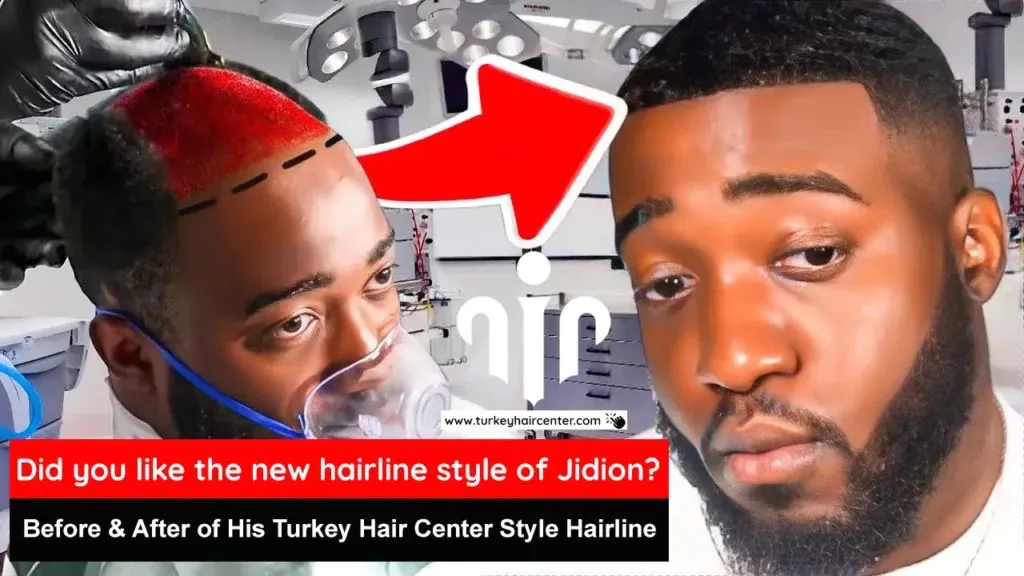 Jidion Adams Hair Transplant Speculation